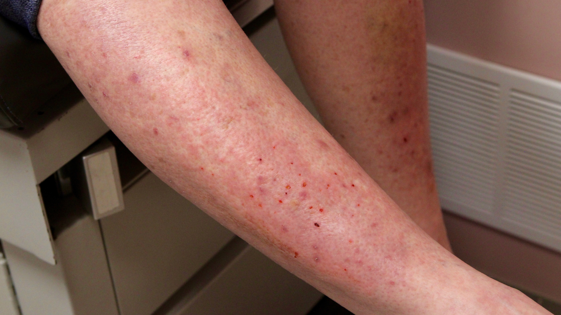 Bl Sdermatoser Dermatitis Herpetiformis Praktisk Medicin