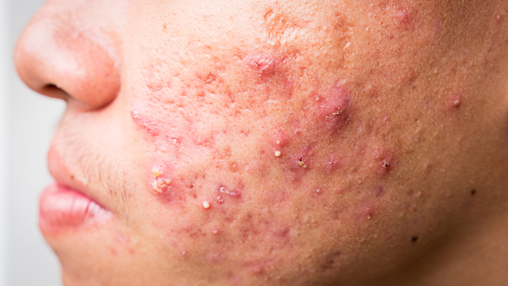 Akne (acne vulgaris, acne tarda) | Praktisk Medicin