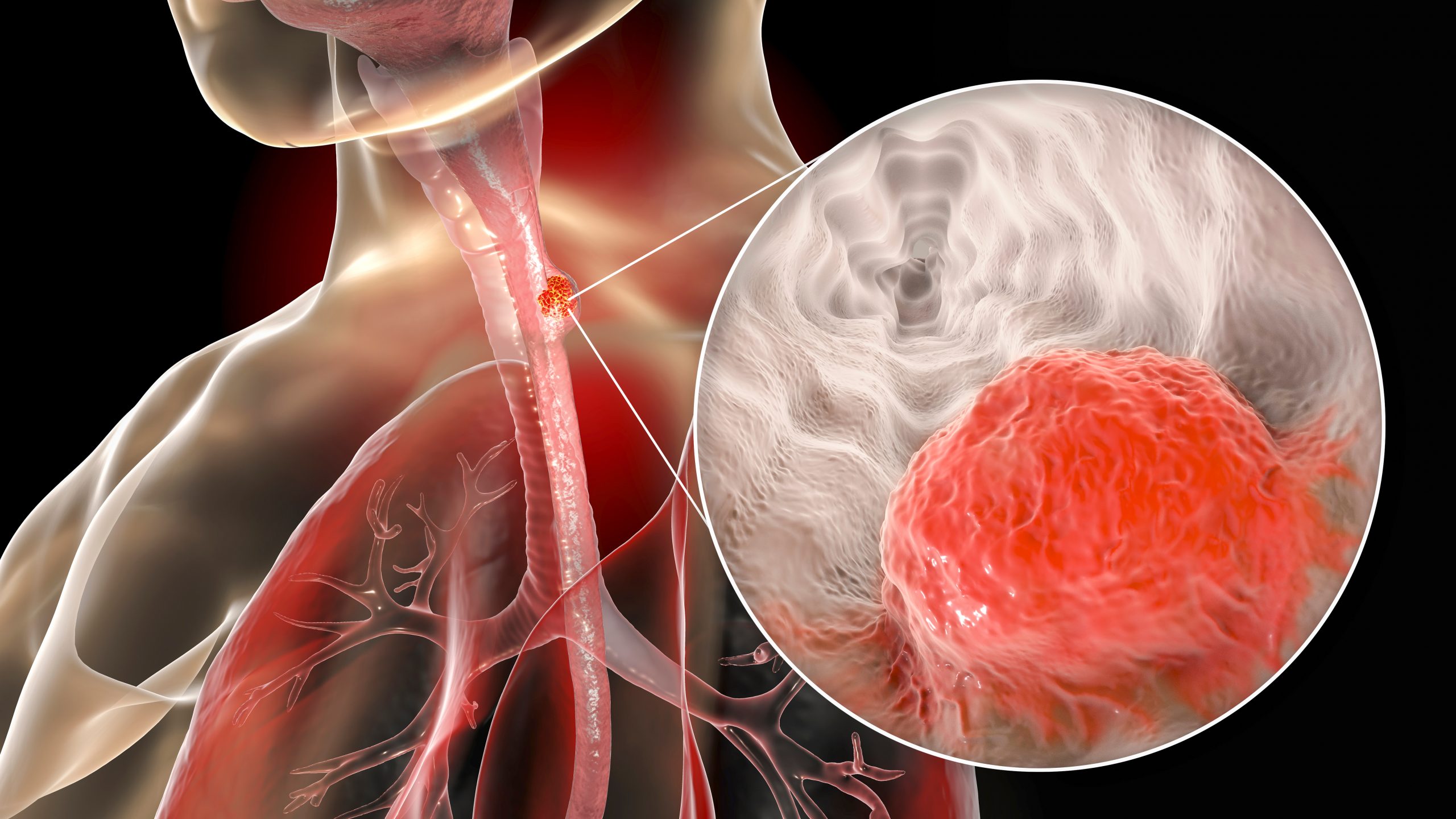 nt-r-det-rekommenderar-opdivo-f-r-adjuvant-behandling-av-avancerad