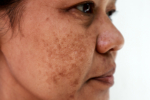 Närbild kvinna med pigmentförändring på kinden. 